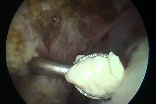 Kalk bleibt in der Nadelöffnung hängen