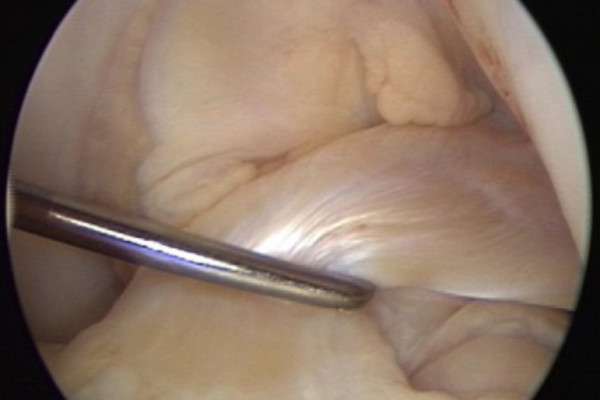 Intaktes vorderes Kreuzband