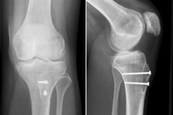 Versetzung des Kniescheibenansatzes