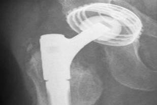 Röntgenbild eines  modularen Schaftrevisionssystem