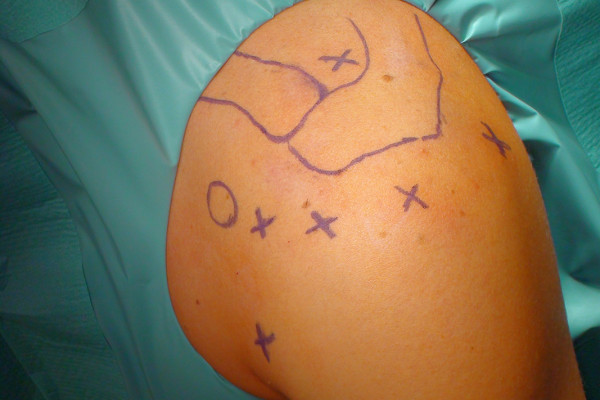 Vorbereitung der Schulter die für eine Arthroskopie