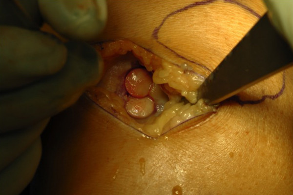 Auffüllung des entstandenen Defektes mittels Knorpel-Knochentransfer
