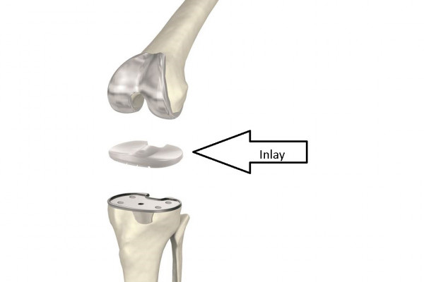Inlay