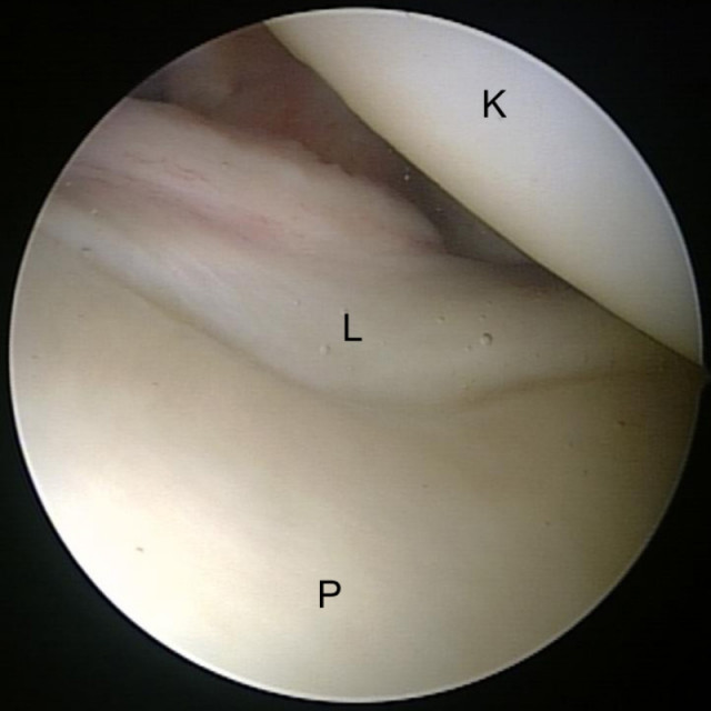 Gesunde Schulter mit normalem Knorpel