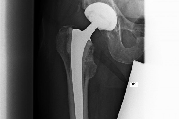 Röntgenbild eines Langschaftes