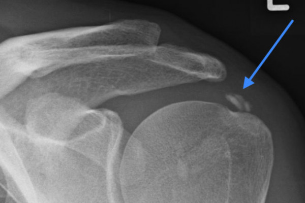 Kalkschulter Tendinosis Calcarea