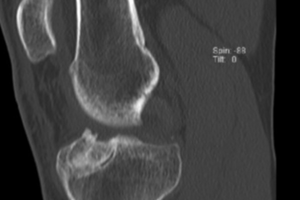 Auffüllung des geweiteten Bohrkanales