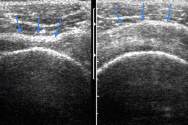 Rotatorenmanschettendefekt