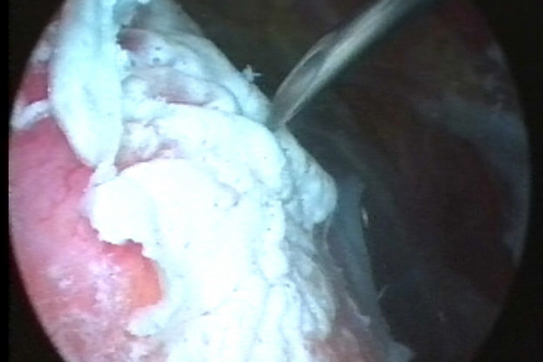 Starken Entzündung an der Sehne