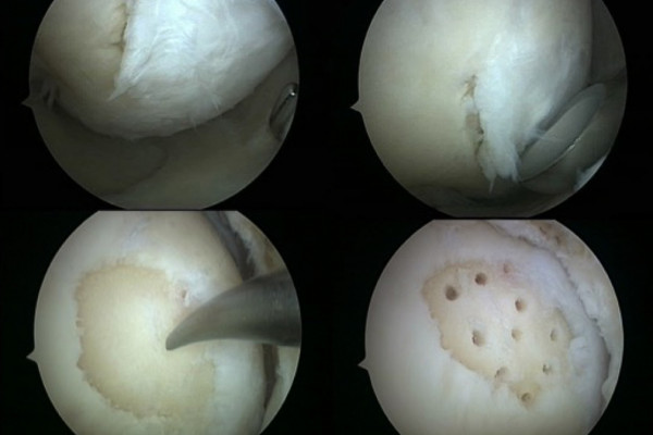 Technik der Mikrofrakturierung