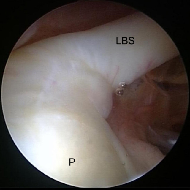 Gesunde Schulter mit normalem Abgang