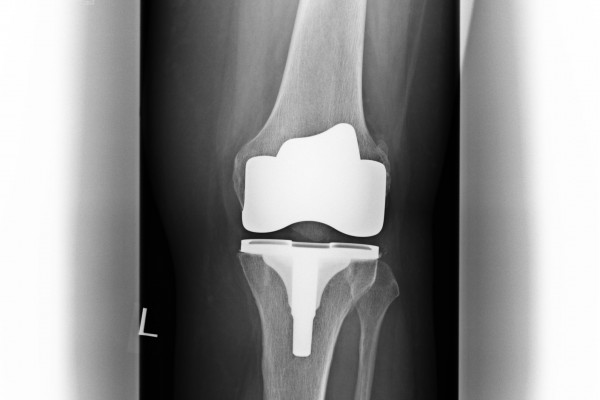 Oberflächenersatz in Frontansicht und Seitansicht