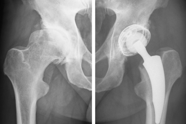 TEP Hüfte Hüftprothesen