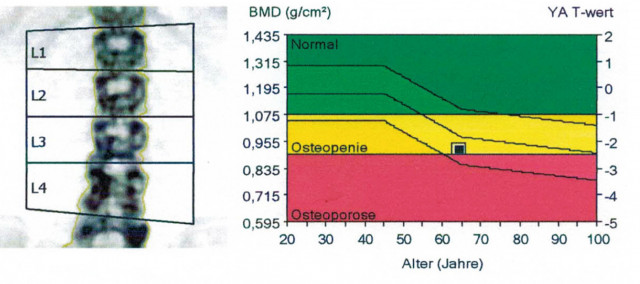 Knochendichtemessung Wirbelsäule