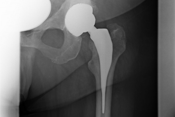 Röntgenbild eines Individualschaftes