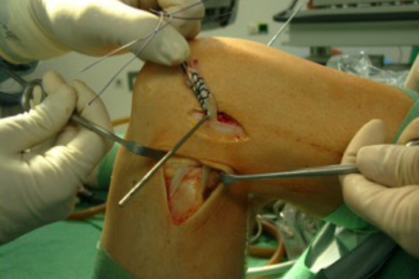 Rekonstruktion der Außenbänder des Kniegelenkes