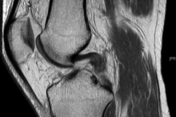 Riss des hinteren Keuzbandes