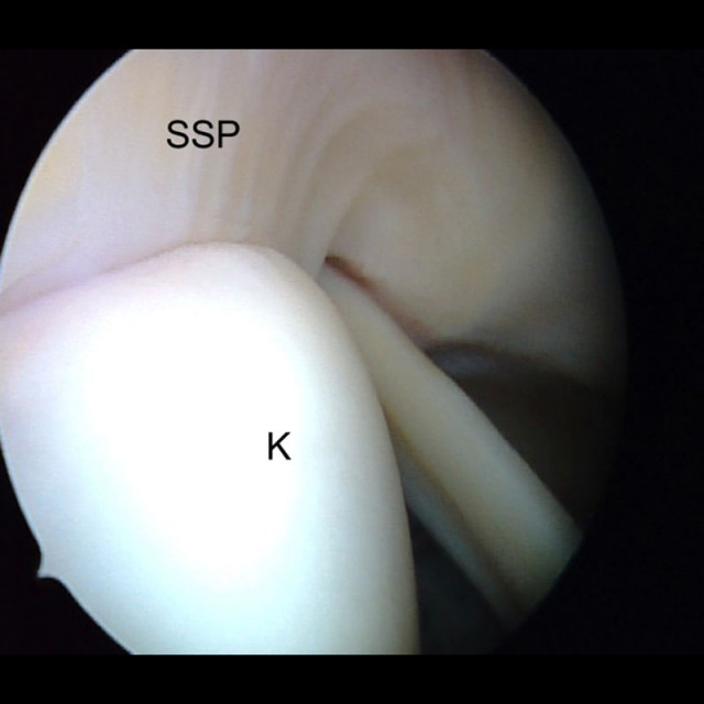 Arthroskopisches Bild einer gesunden Rotatorenmanschette (SSP)