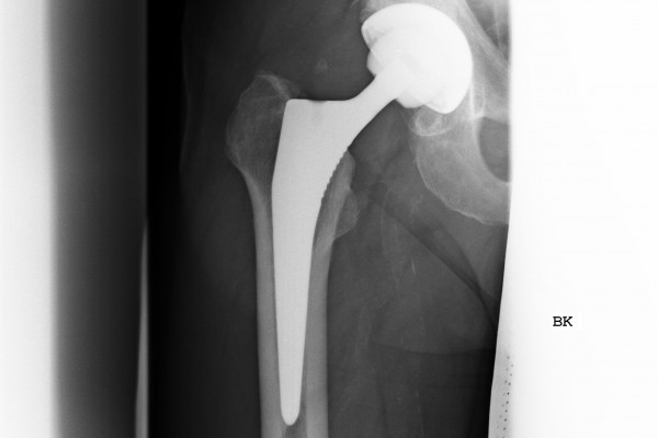 Röntgenbild einer anatomischen Geradschaftprothese