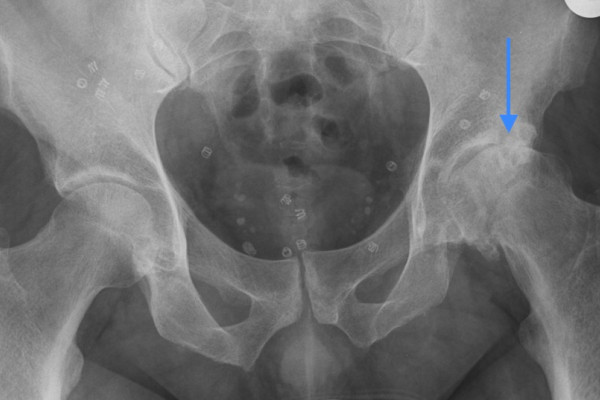 Schwere Arthrose der Linken Hüfte