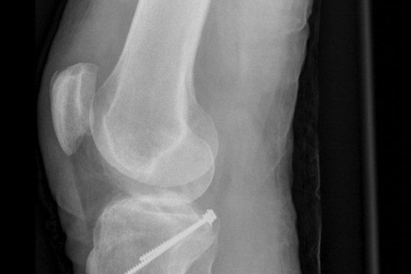 Knöcherner Ausriss des hinteren Kreuzbandes