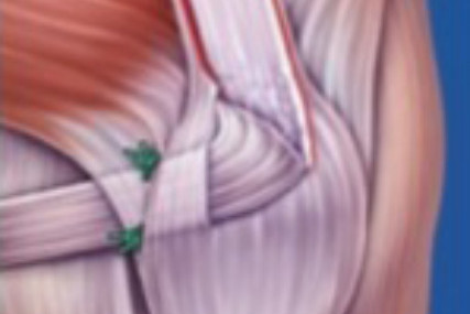 Stabilisierung der Kniescheibe durch eine Bandplastik