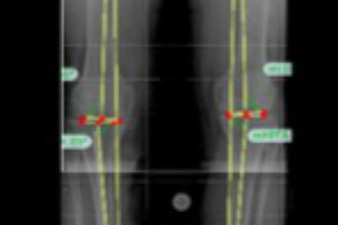 Ausmessen der Beinachse