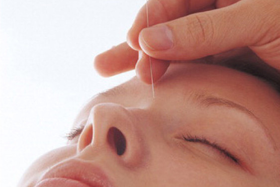 Gesicht mit Akupunkturnadel