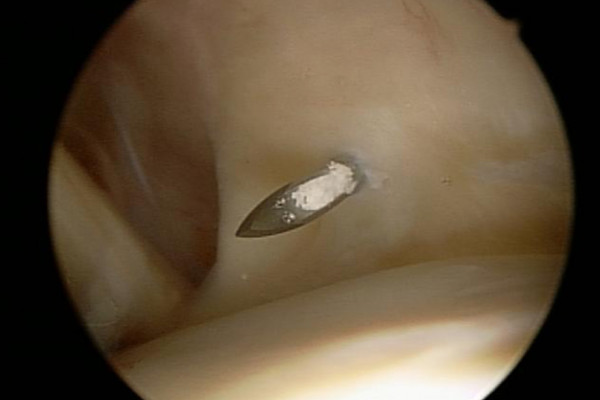 Kalkherd mit einer Hohlnadel