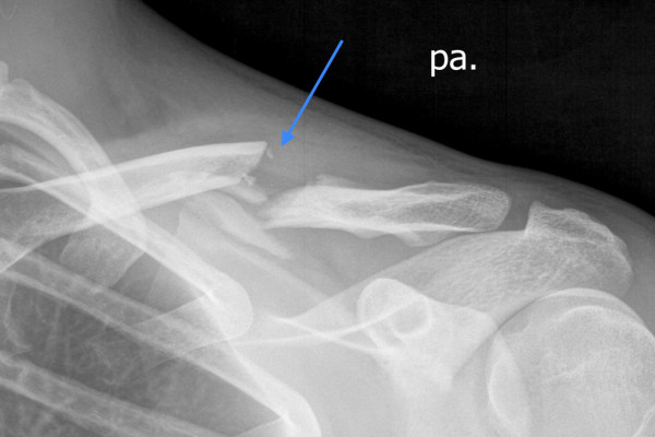 Verschobener Bruch des Schlüsselbeins