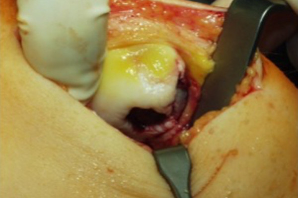 Ausbruch eines Knorpelstückes aus der Kniescheibe