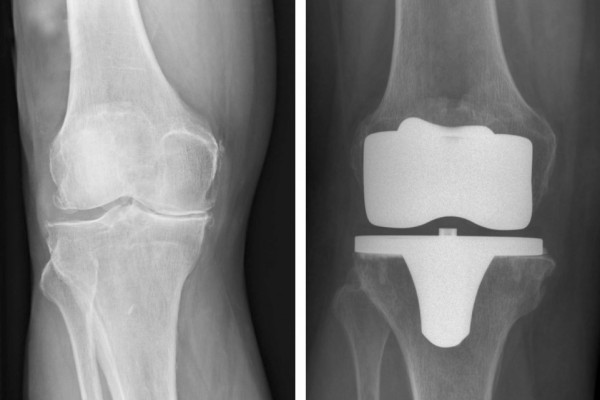 TEP Knie Knieprothese