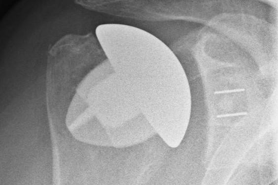 Schaftfreie Schulterprothese