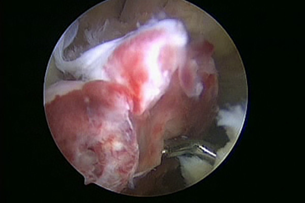 Knöcherner Ausriss des vorderen Kreuzbandes