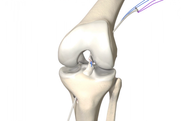 Dynamische intraligamentäre Stabilisierung