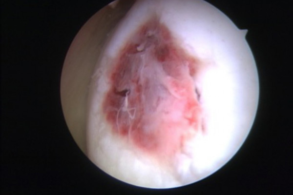 Ergebnis 6 Wochen nach Mikrofrakturierung