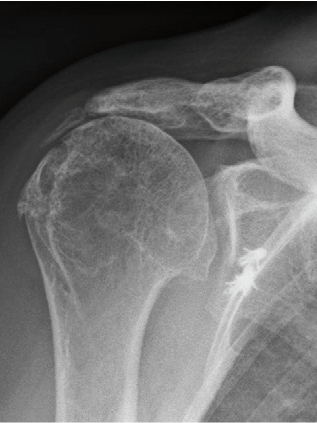 Arthrose mit Gelenkspalt