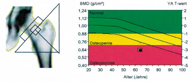 Knochendichtemessung Hüfte