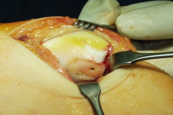 Refixation des Knorpelstückes