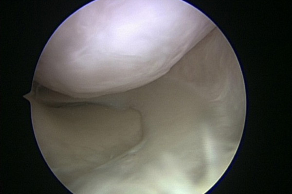 Ergebnis 1 Jahr nach Knorpelzelltransplantation